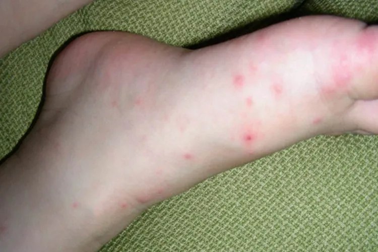 小孩手足口病轻微图片