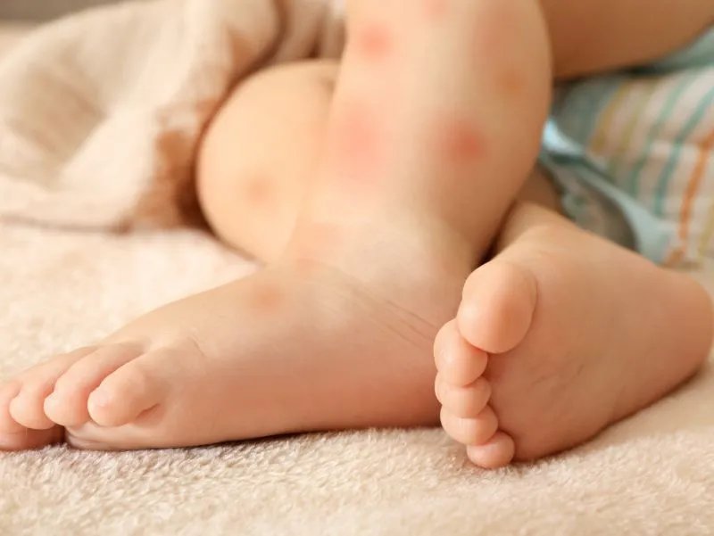 宝宝被蚊子咬了怎么办