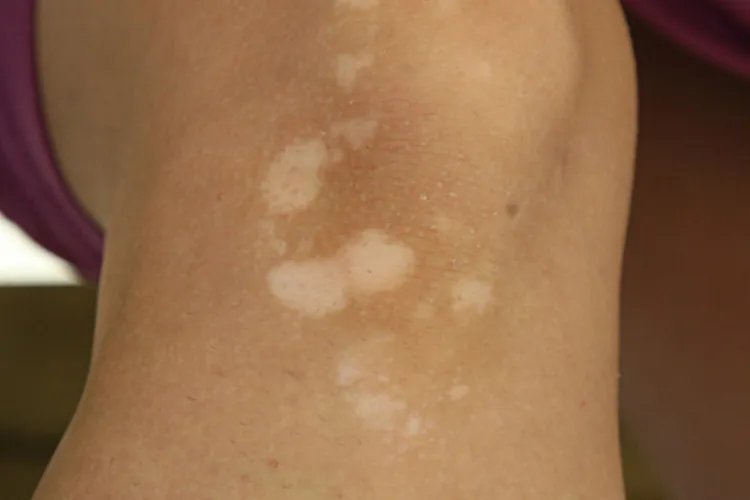 淡白色白斑图片大全