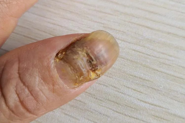 灰指甲图片怎么治疗