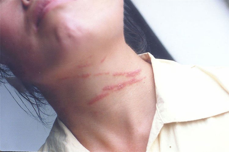 影子虫咬伤初期图片