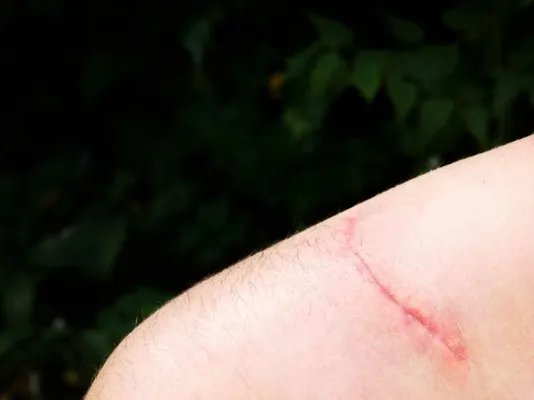 疤痕体质怎么办