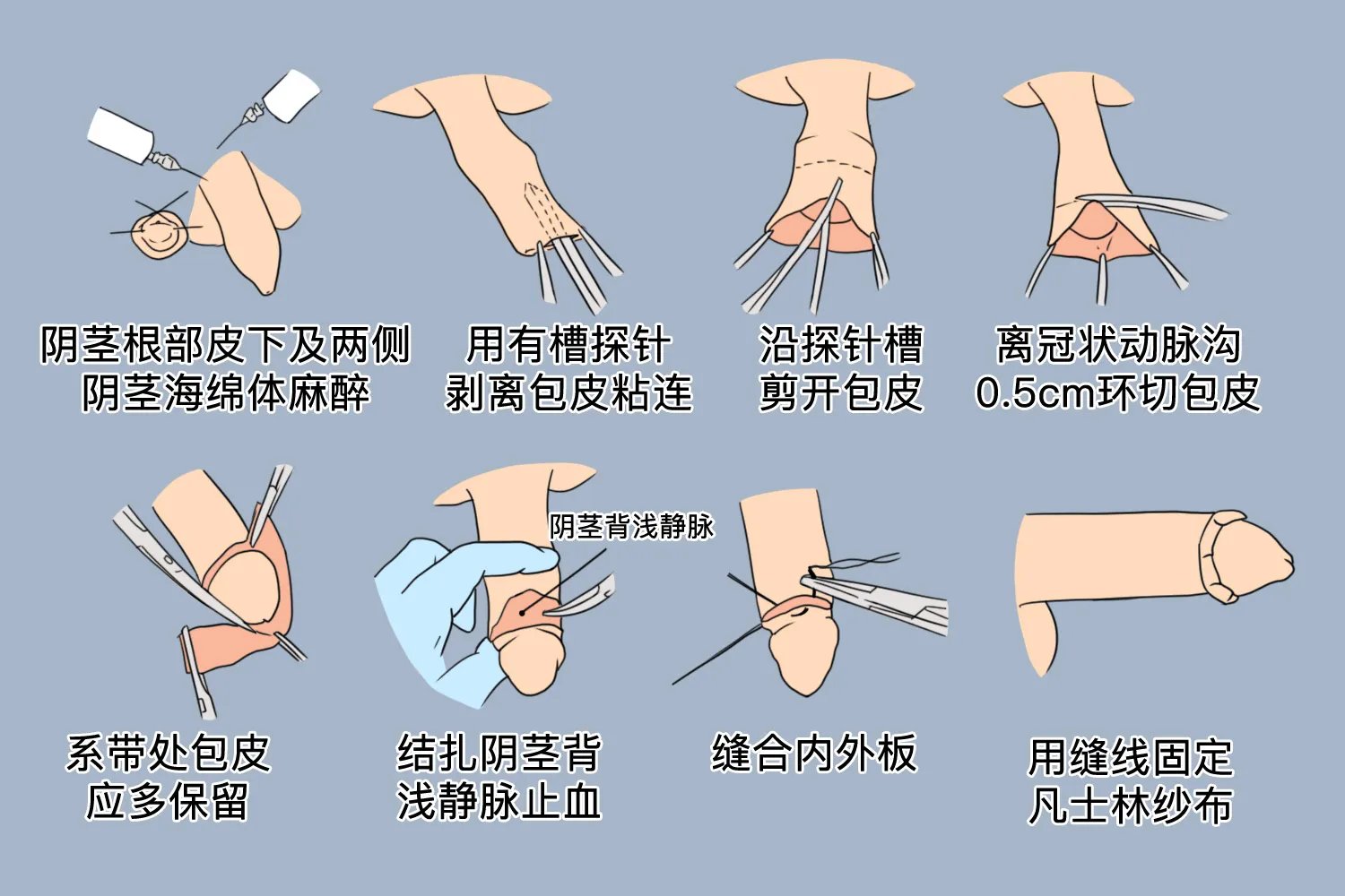 切包茎手术过程图片