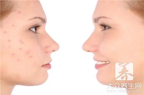 巴复平对痘印有效吗