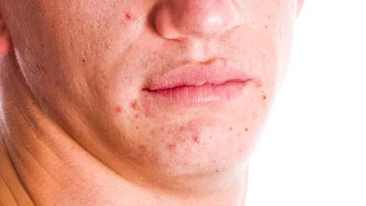 湿疹如何进行家庭治疗呢