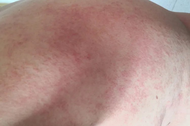 成人红痱子症状图片