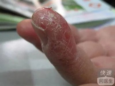 气性坏疽的隔离措施有哪些  如何治疗气性坏疽