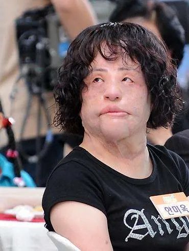 曾是高配版林允儿，整容上瘾后自己注射色拉油，结果怎么样了呢？