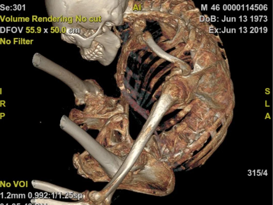打开折叠人生——极重度脊柱后凸3-ON折叠人手术
