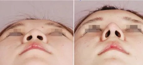 自体脂肪隆鼻要怎么做