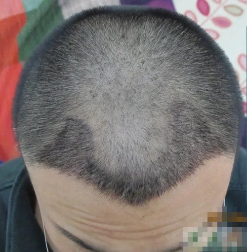 种植头发需要多少钱