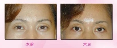 韩式去眼袋多少钱