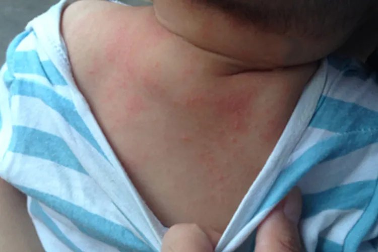 孩子身上起红疙瘩很痒图片