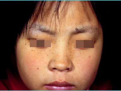 进行性色素性紫癜性皮肤病症状图片