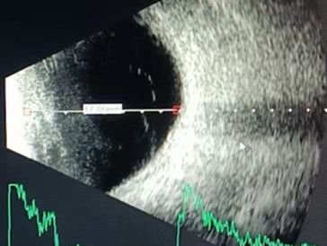 配戴凸透镜框架眼镜治疗成人远视