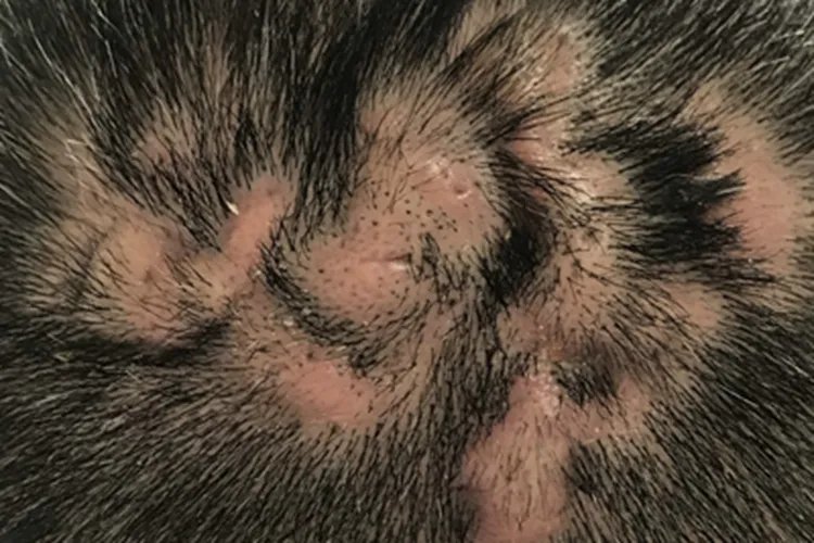 秃发性毛囊炎瘢痕图片