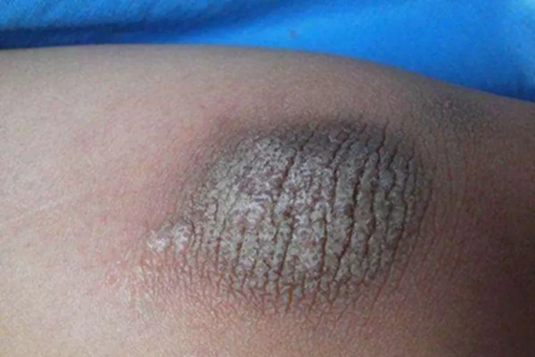 摩擦黑变病肘部皮肤粗糙图片