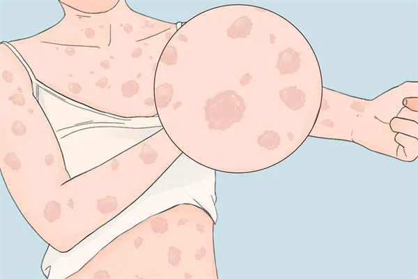 皮肤过敏吃什么药好