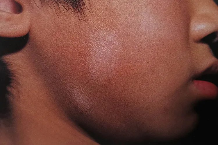 淡白色白斑图片大全