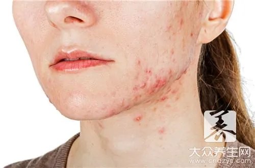 巴复平对痘印有效吗