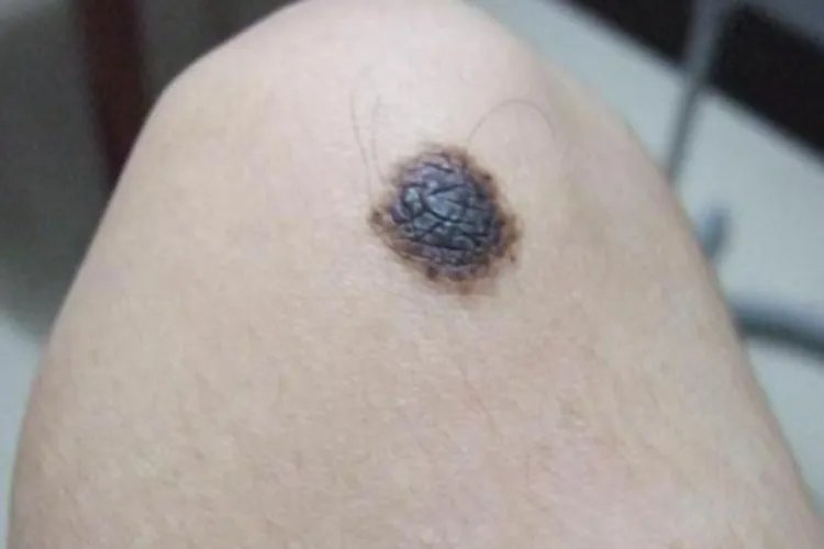 复合痣黑痣图片