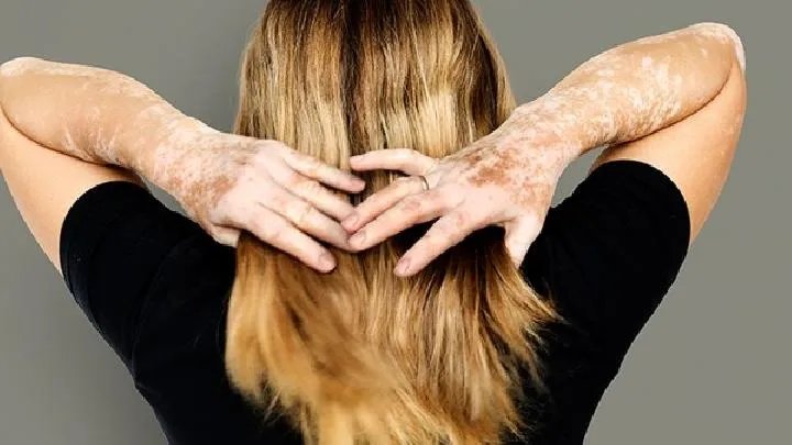 皮肤蝇蛆病应该做哪些检查？