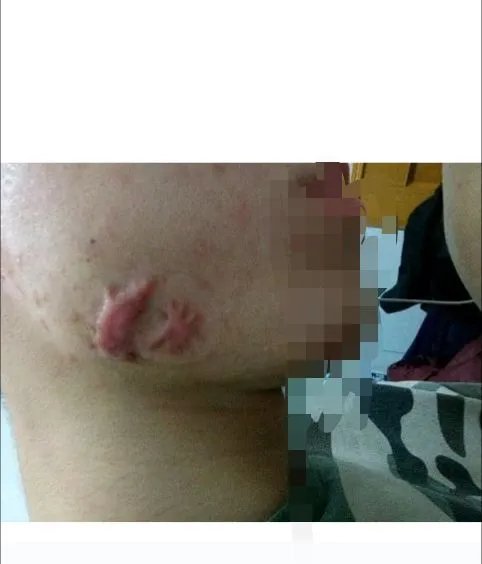 瘢痕疙瘩患者所关心的同位素敷贴问题