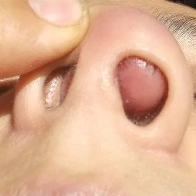 尘螨过敏性鼻炎是怎么回事?