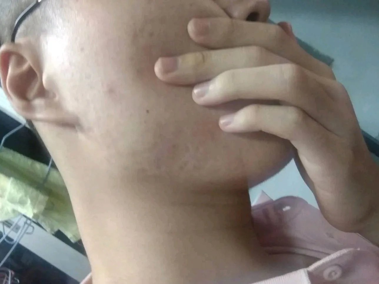 瘢痕疙瘩患者所关心的同位素敷贴问题