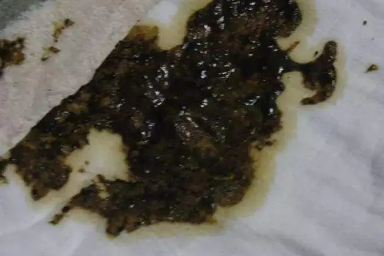 大便颜色9种图解