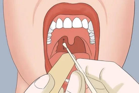 咽拭子采样三个部位的具体图片