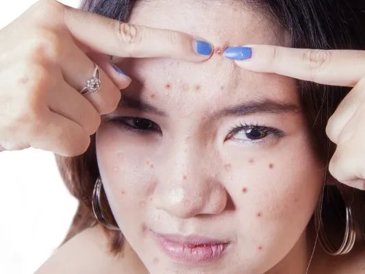 脸颊长痘痘是怎么回事