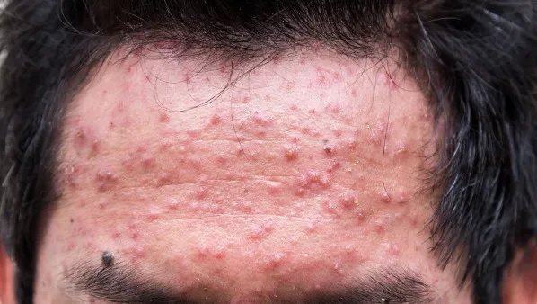 怎样快速治疗痤疮