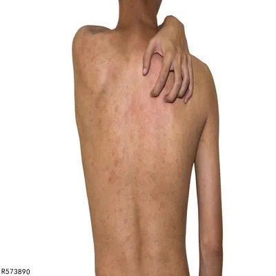 日光皮炎应该用什么药