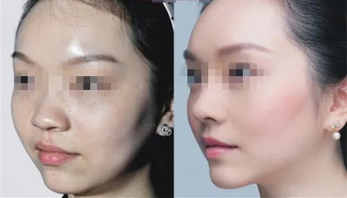 打玻尿酸丰面颊多少钱