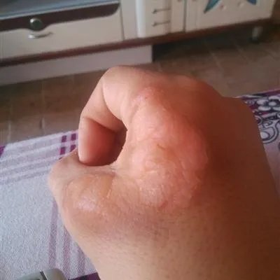 皮下脓肿饮食有哪些注意事项