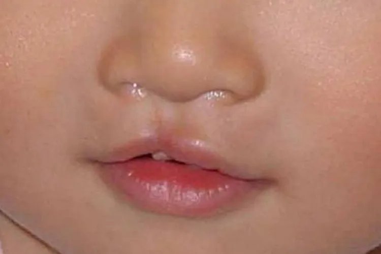 唇腭裂和兔唇的区别图片