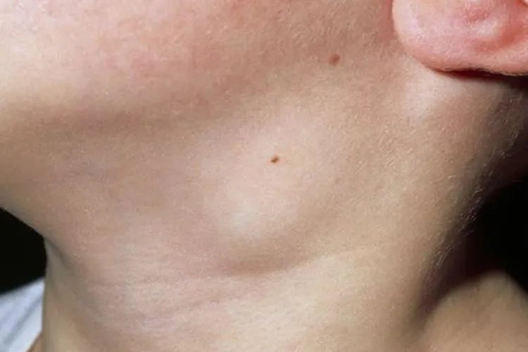 脖子淋巴癌早期图片