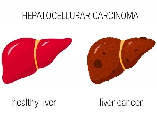 肝癌晚期能活多久呢
