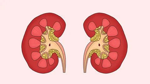 肾结石治疗最佳方案