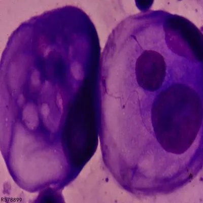 治疗绒毛膜癌主要方法