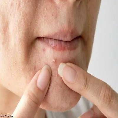 长痤疮怎么调理 长痤疮的5个调理方法盘点