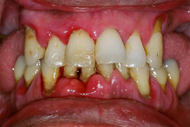 牙周炎图片