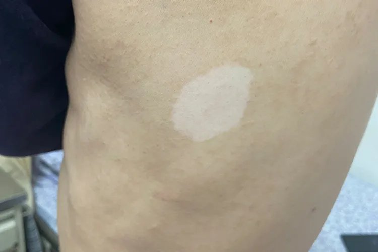 淡白色白斑图片大全