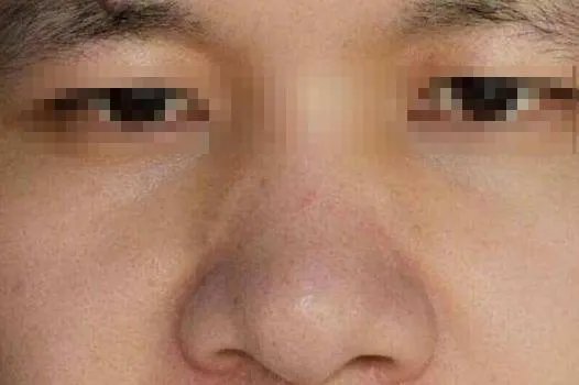 鼻型图片