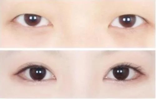 上睑下垂要多少钱