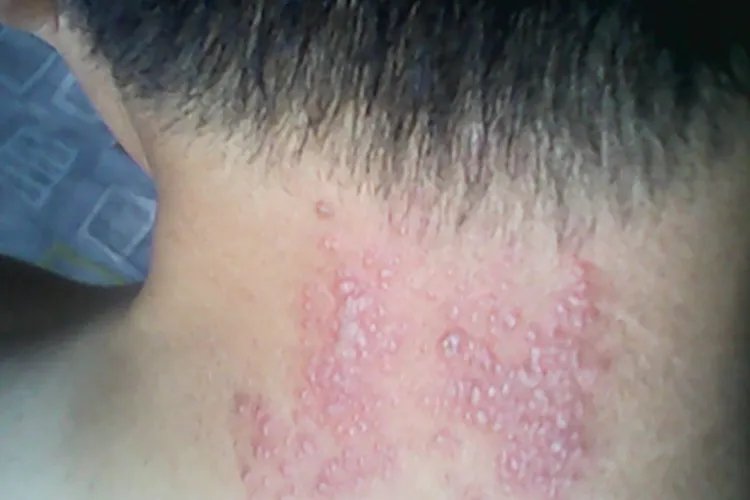 螨虫皮炎症状图片