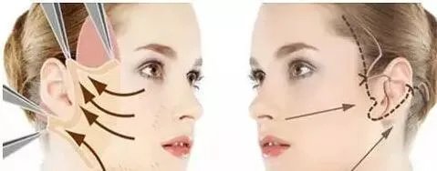 手术除皱多少钱