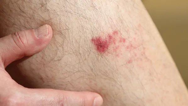 伤口发炎怎么处理