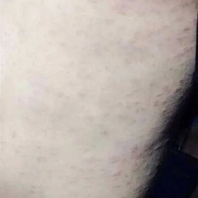 皮下脓肿饮食有哪些注意事项